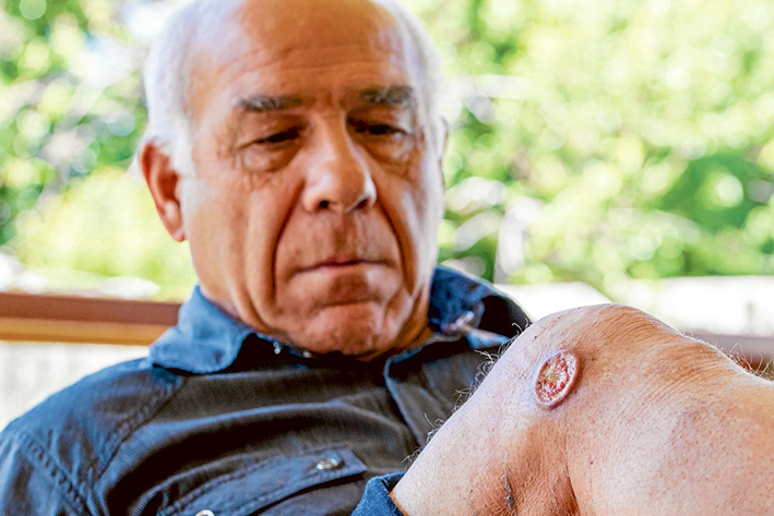 Sore spot: Rye’s Vincent Misitano thought his ulcer was just a harmless insect bite. Picture: Yanni